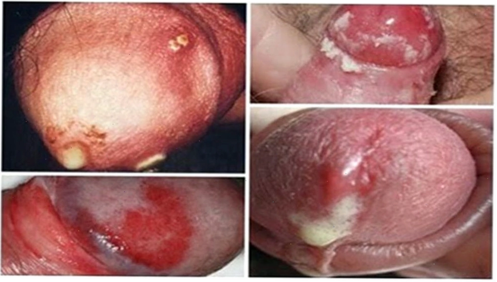 Hình ảnh bệnh lậu ở nam giới