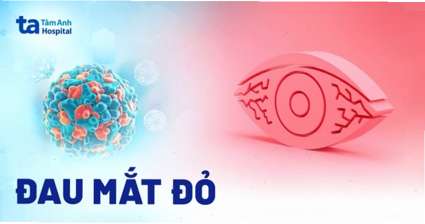Hình ảnh bệnh nhân bị đau mắt đỏ