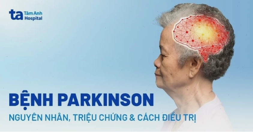 Hình ảnh biểu đồ giải thích bệnh Parkinson