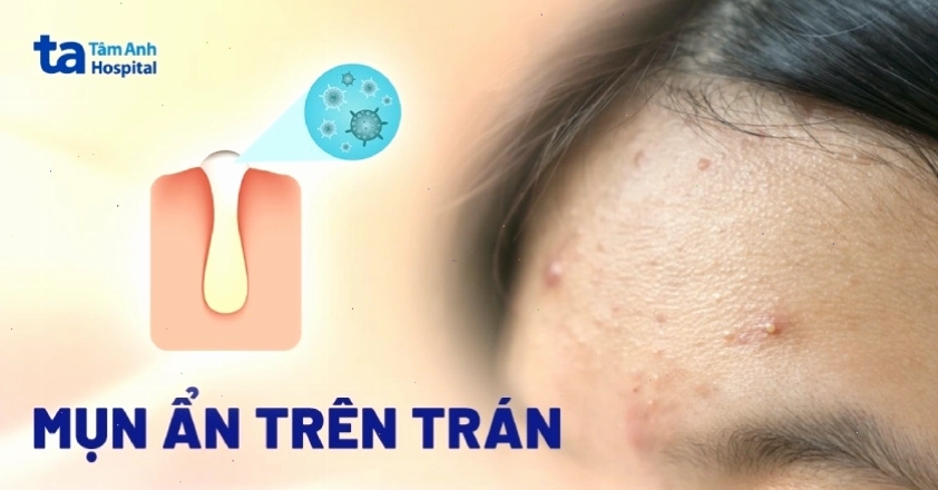 Hình ảnh các nốt mụn ẩn li ti trên trán