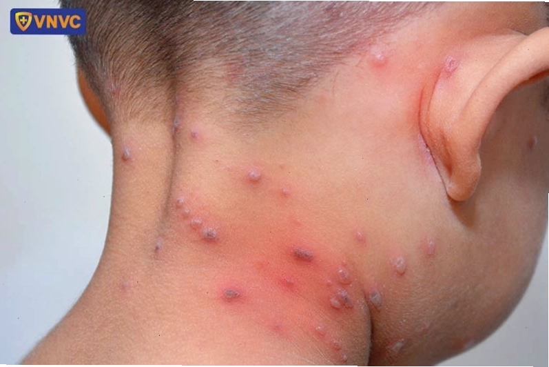 Hình ảnh các nốt phỏng dạ ở giai đoạn phát triển