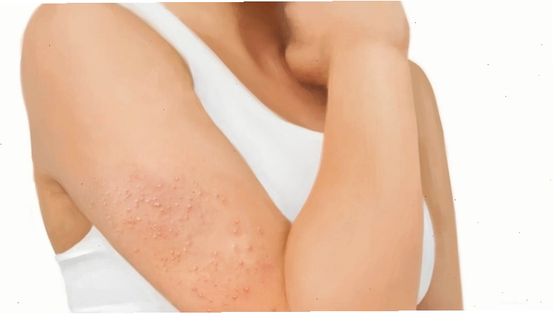 Hình ảnh cận cảnh các nốt mụn sần nhỏ li ti xuất hiện trên bắp tay do tình trạng dày sừng nang lông