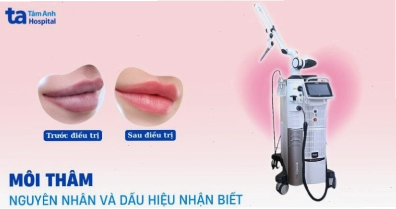 Hình ảnh cận cảnh môi bị thâm
