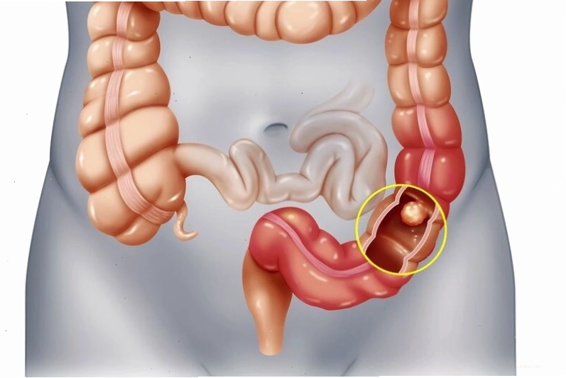 Hình ảnh cảnh báo dấu hiệu ung thư đại tràng