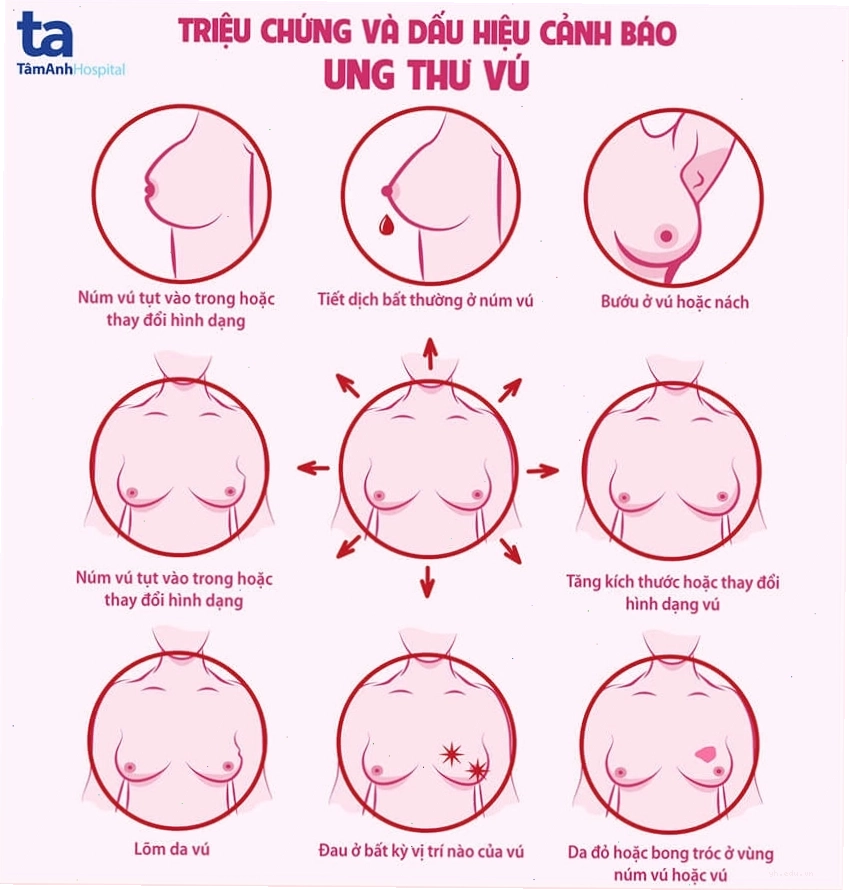 Hình ảnh đồ họa về dấu hiệu nhận biết ung thư vú