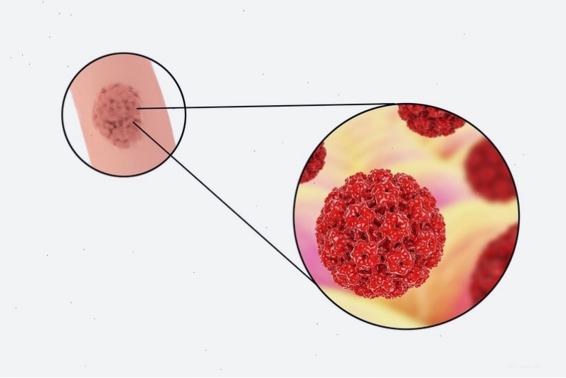 Hình ảnh đồ họa về nguy cơ nhiễm virus HPV trong cộng đồng