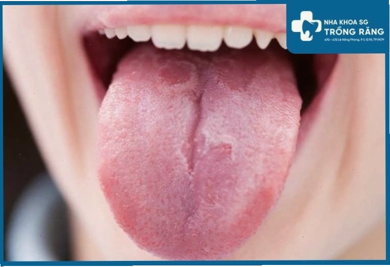 Hình ảnh gai lưỡi bị tổn thương, có màu đậm hơn so với màu sắc thông thường