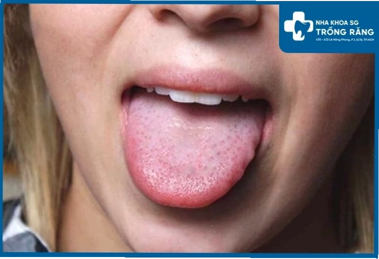 Hình ảnh gai lưỡi xuất hiện nhiều nốt ửng đỏ sưng viêm