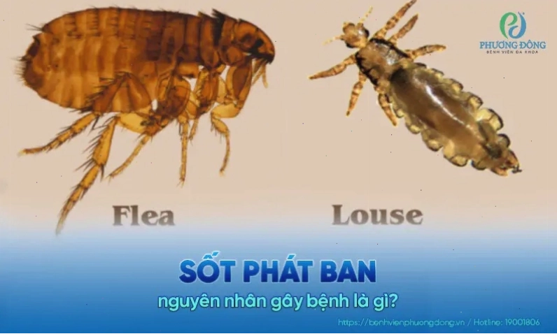 Hình ảnh giải thích nguyên nhân gây ra bệnh sốt phát ban
