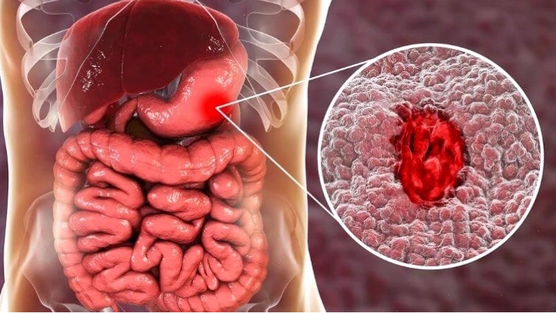 Hình ảnh loét dạ dày gây ảnh hưởng đến tiêu hóa