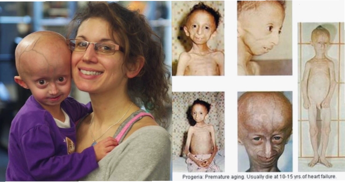 Hình ảnh minh họa ảnh hưởng của bệnh Progeria đối với trẻ