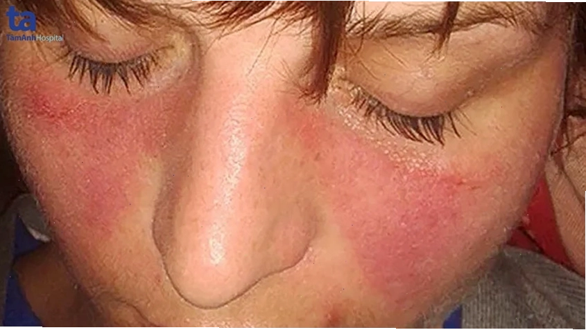 Hình ảnh minh họa bệnh Lupus ban đỏ hệ thống