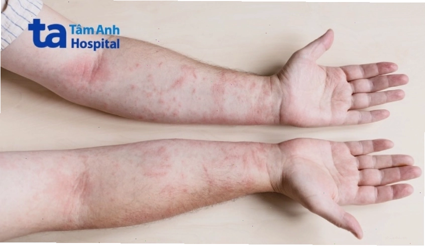 Hình ảnh minh họa bệnh viêm da tiếp xúc