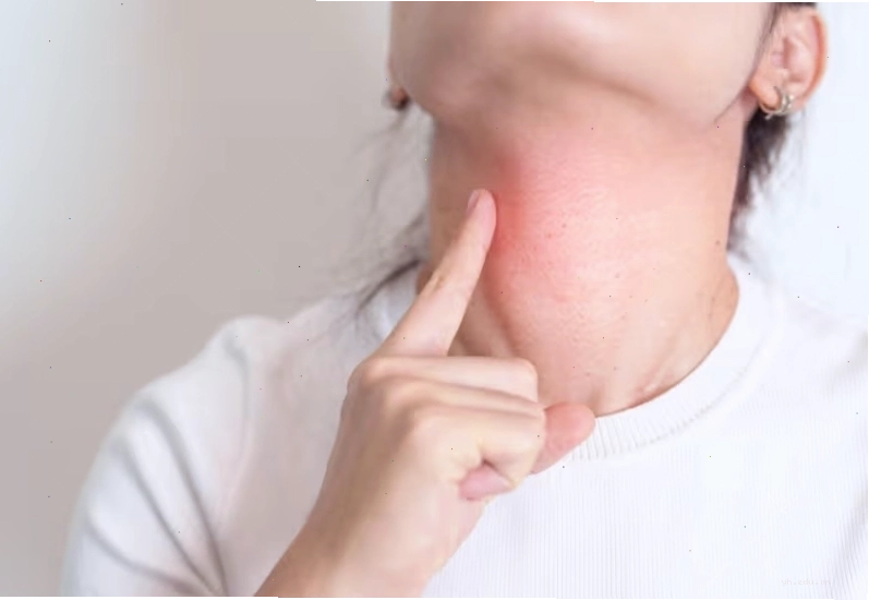 Hình ảnh minh họa bướu cổ do thiếu hụt vi chất