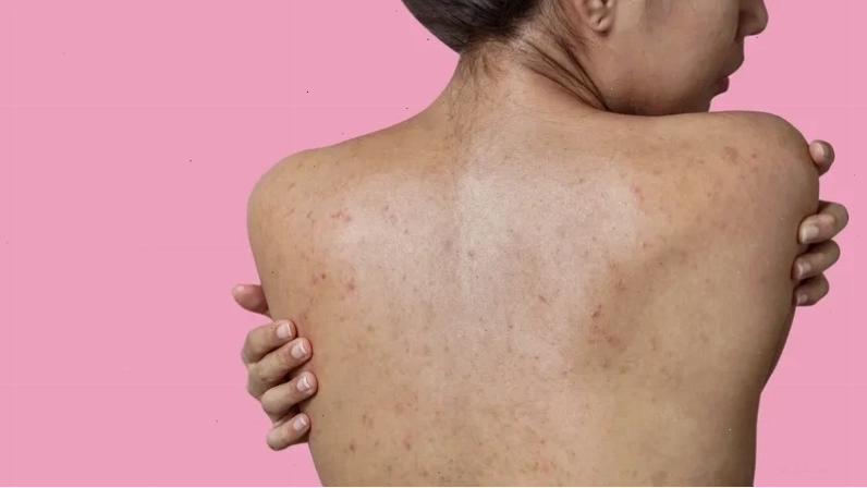 Hình ảnh minh họa các nốt mụn đỏ rải rác trên vùng da lưng