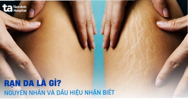 Hình ảnh minh họa các vết rạn da trên cơ thể con người