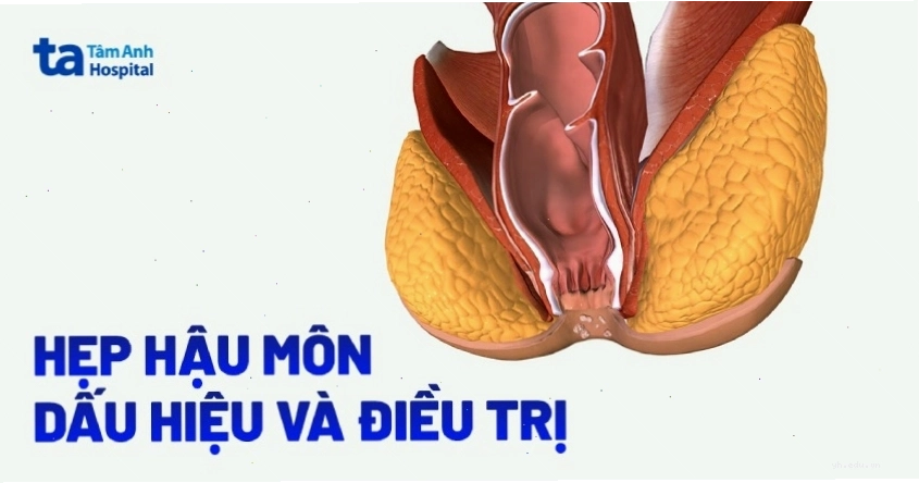 Hình ảnh minh họa cấu trúc giải phẫu vùng ống hậu môn bình thường và vùng bị hẹp