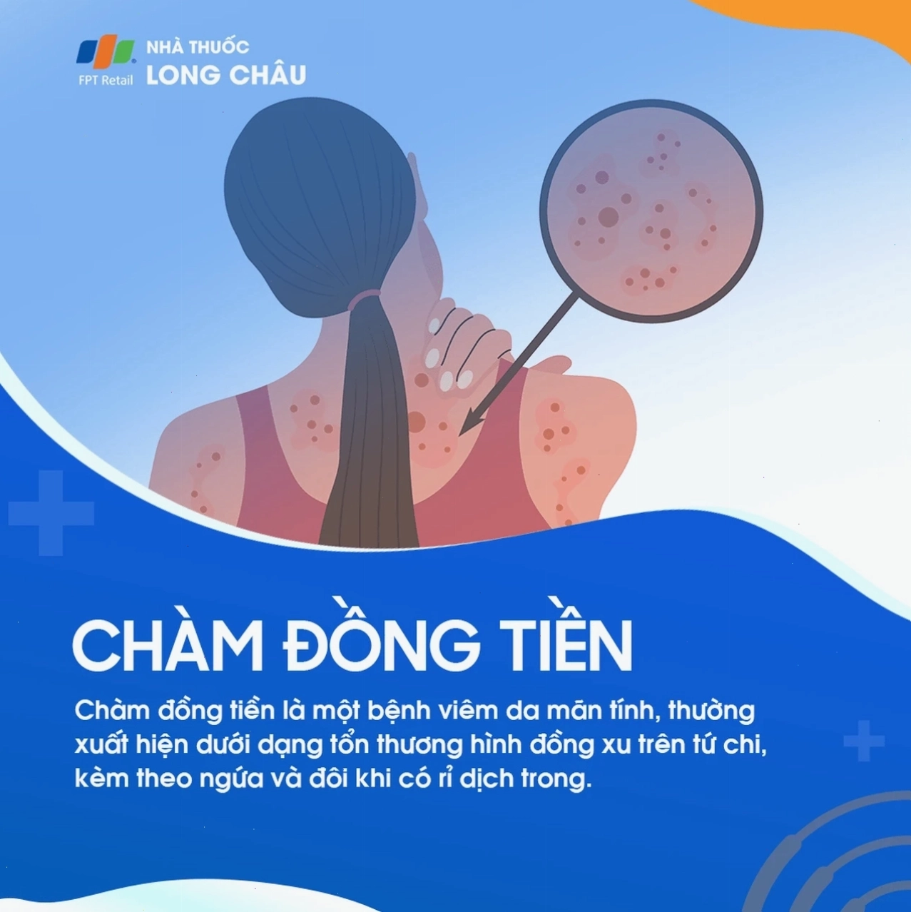 Hình ảnh minh họa chàm đồng tiền hay còn gọi là viêm da dạng đĩa