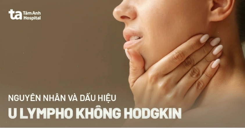 Hình ảnh minh họa đặc điểm của u lympho không Hodgkin