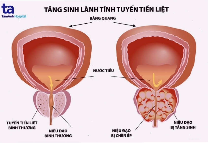 Hình ảnh minh họa giải phẫu tuyến tiền liệt bị phì đại so với kích thước bình thường