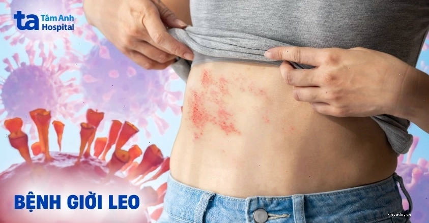 Hình ảnh minh họa làn da bị tổn thương bởi virus Zona thần kinh