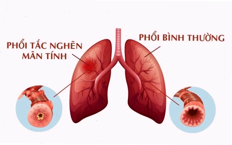 Hình ảnh minh họa lối sống không khói thuốc lá để bảo vệ phổi