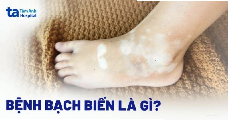 Hình ảnh minh họa mảng da bị mất sắc tố đặc trưng của bệnh bạch biến