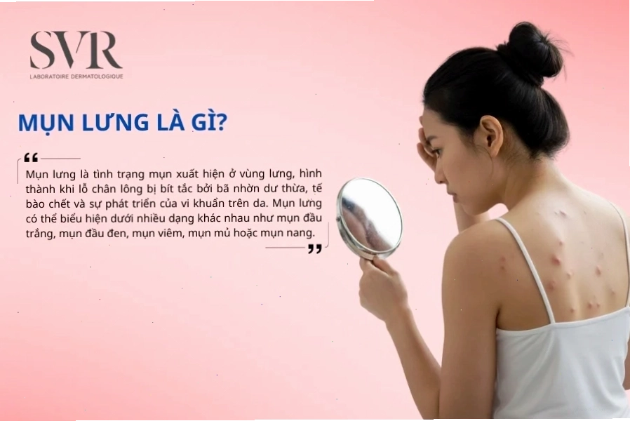 Hình ảnh minh họa mụn lưng
