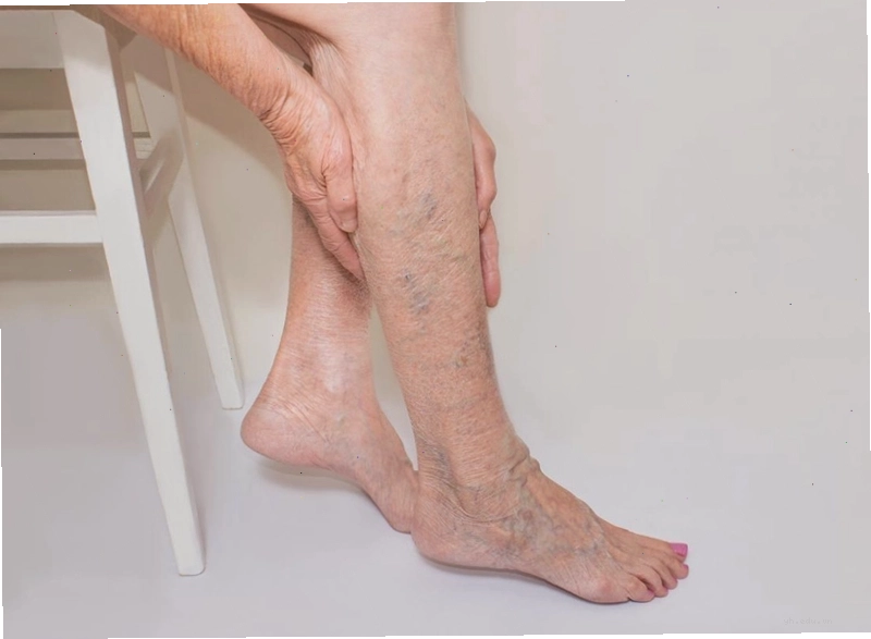 Hình ảnh minh họa phụ nữ mắc bệnh suy giãn tĩnh mạch chân