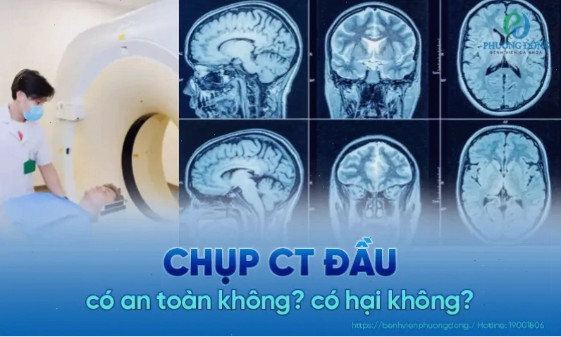 Hình ảnh minh họa quy trình chụp CT đầu an toàn cho bệnh nhân