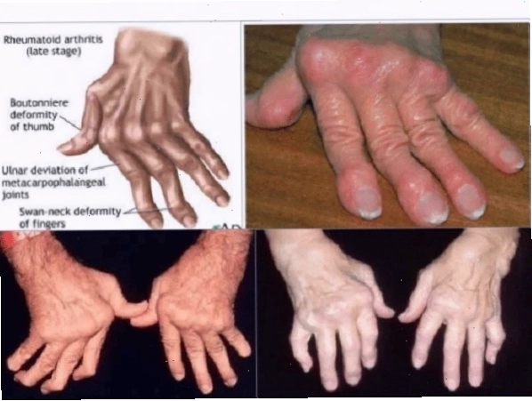 Hình ảnh minh họa tình trạng biến dạng khớp tay do bệnh phong thấp lâu ngày