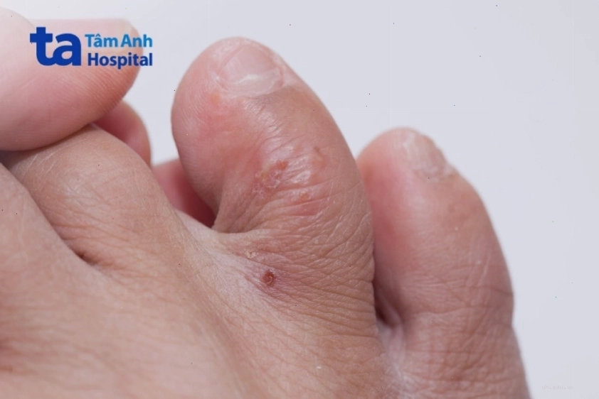 Hình ảnh minh họa tình trạng chàm tổ đĩa