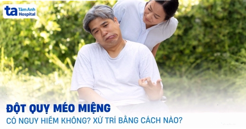 Hình ảnh minh họa tình trạng méo miệng do đột quỵ