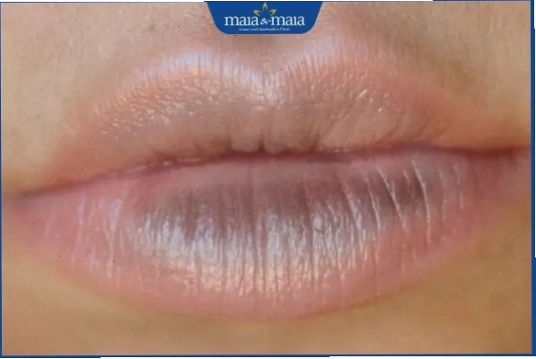 Hình ảnh minh họa tình trạng môi bị thâm đen ở người trưởng thành