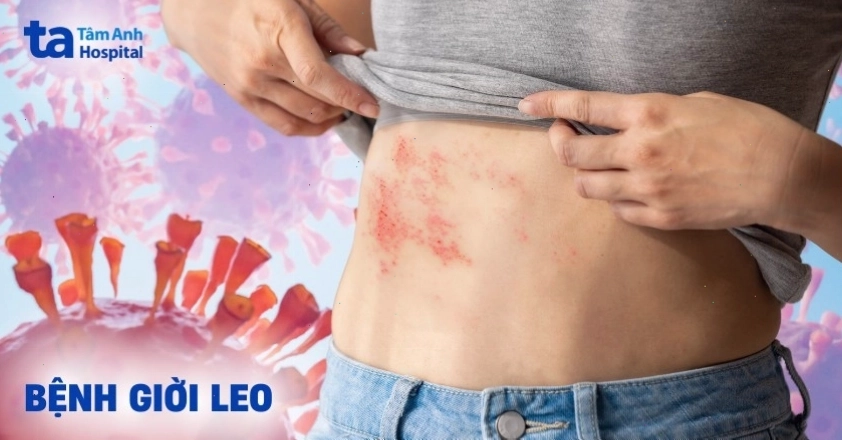 Hình ảnh minh họa tổn thương da do bệnh giời leo