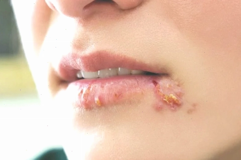 Hình ảnh minh họa tổn thương mụn rộp do virus Herpes gây ra cảm giác tê bì tại môi