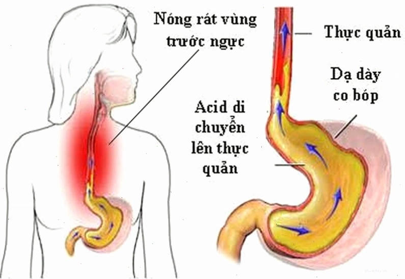 Hình ảnh minh họa trào ngược dạ dày gây chảy nước dãi khi ngủ
