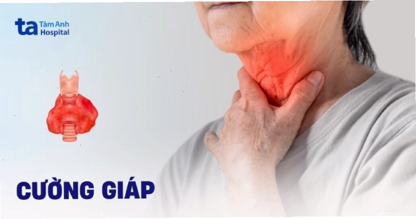 Hình ảnh minh họa tuyến giáp bị kích thích quá mức