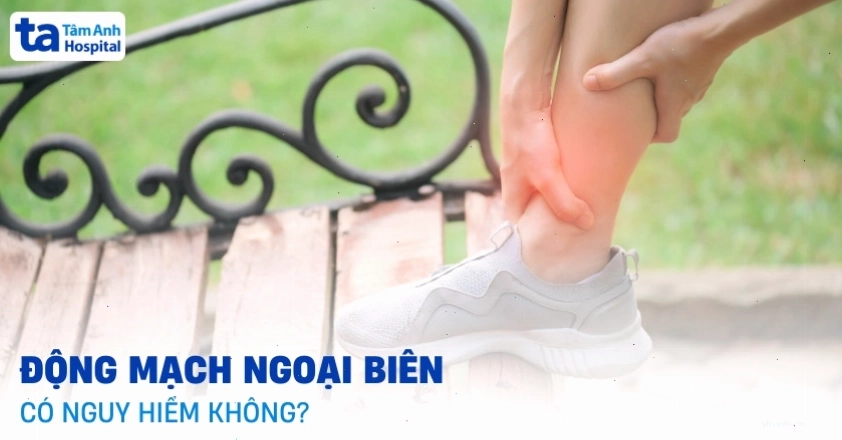Hình ảnh minh họa về bệnh động mạch ngoại biên ảnh hưởng đến chi dưới