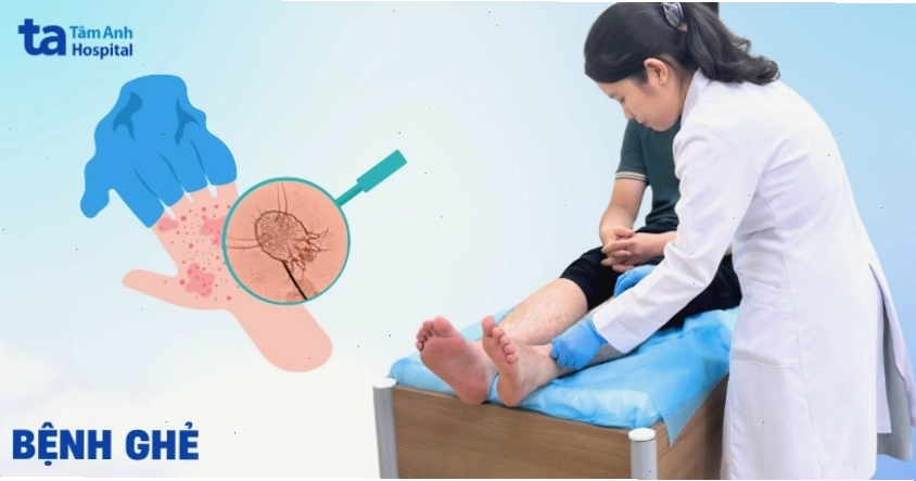 Hình ảnh minh họa về bệnh ghẻ ngứa
