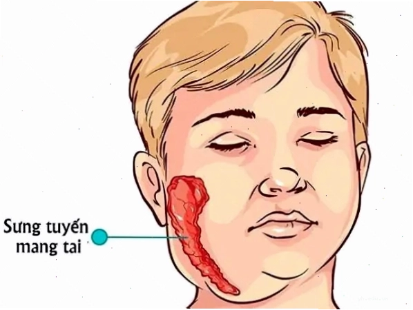 Hình ảnh minh họa về bệnh quai bị hay còn gọi là má chàm bàm