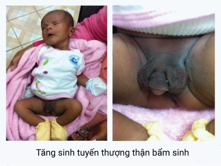 Hình ảnh minh họa về bệnh tăng sinh tuyến thượng thận bẩm sinh