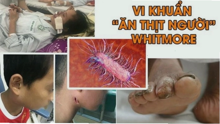 Hình ảnh minh họa về bệnh Whitmore là gì và các khuyến cáo điều trị dự phòng an toàn