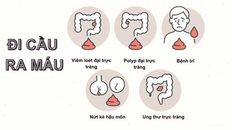 Hình ảnh minh họa về hiện tượng đi ngoài ra máu ở người trưởng thành