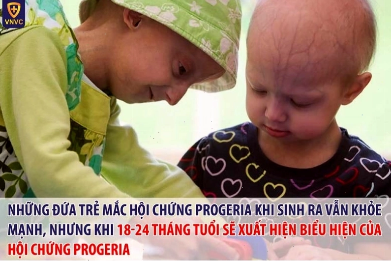 Hình ảnh minh họa về hội chứng lão hóa sớm ở trẻ em