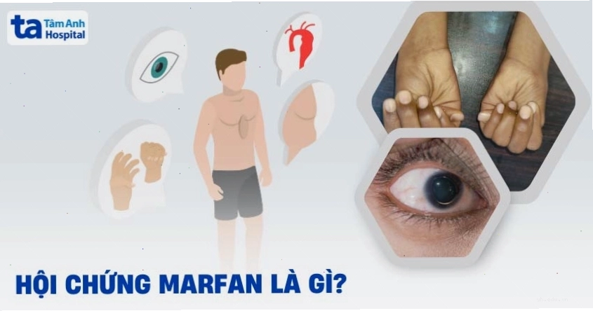 Hình ảnh minh họa về hội chứng Marfan