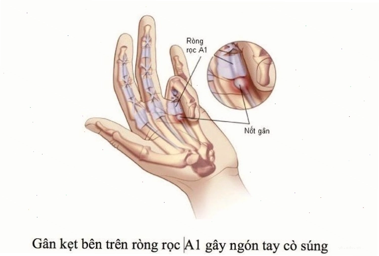 Hình ảnh minh họa về nguyên nhân khiến ngón tay không thể co duỗi linh hoạt do tổn thương cơ khớp