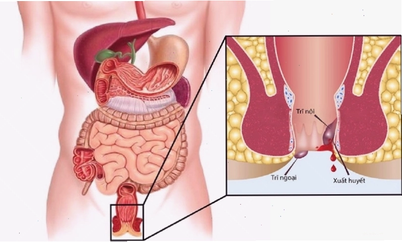 Hình ảnh minh họa về tình trạng chảy máu hậu môn không đau