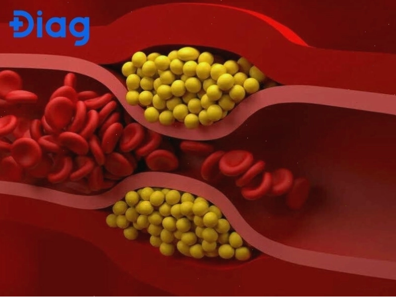 Hình ảnh minh họa về tình trạng tăng lipid máu trong cơ thể người