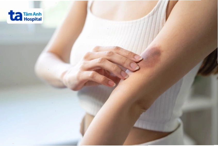 Hình ảnh minh họa vết bầm tím trên bề mặt da
